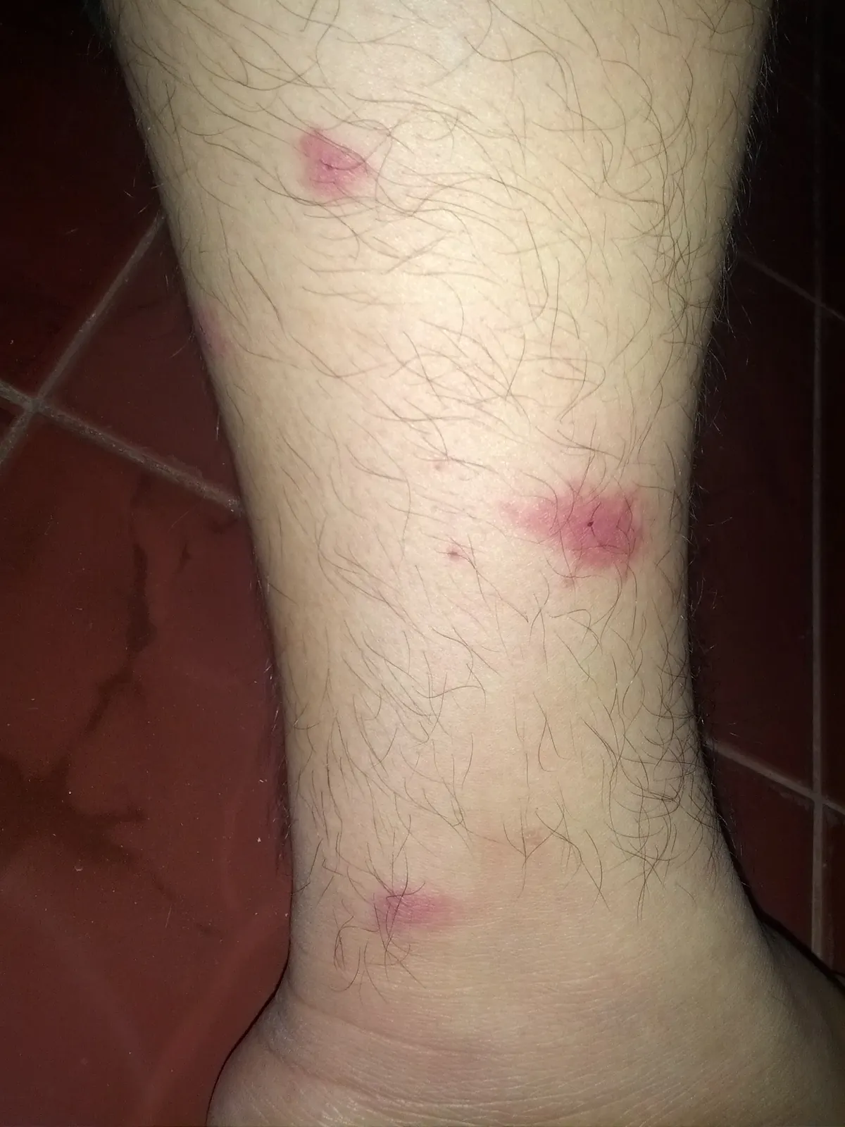 Mosquito bites on a person's leg, showing raised pink welts of different sizes